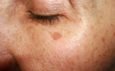 Sun Safety & Outdoor Protection for Aging Skin